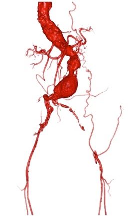 Tratamento de Aneurisma da Aorta Abdominal