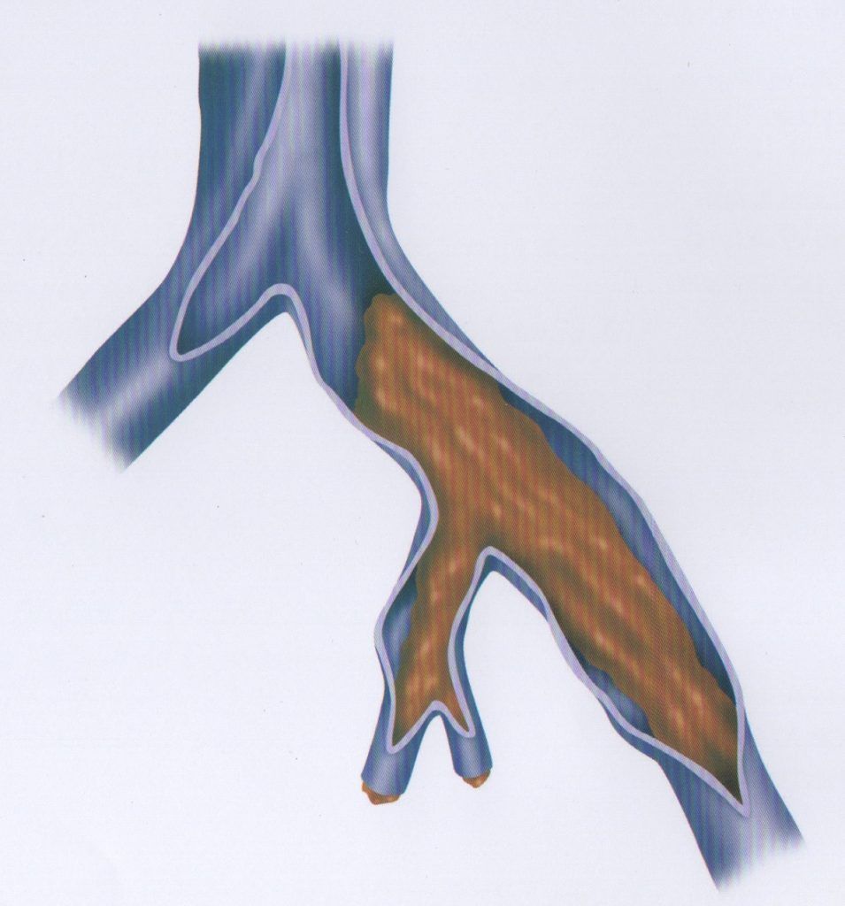 TROMBOSE VENOSA