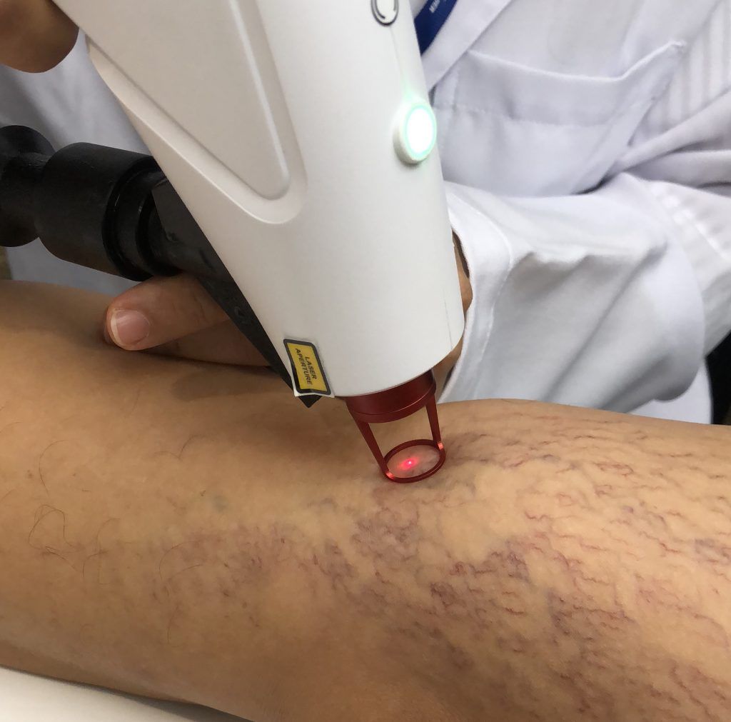 Escleroterapia com Laser