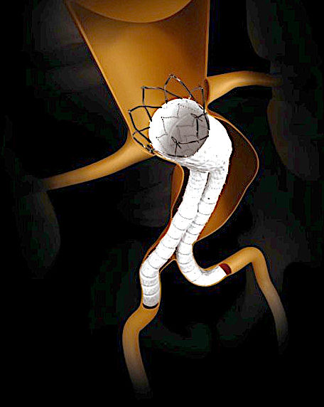 Endoprótese para tratamento de aneurisma da Aorta Abdominal (AAA).