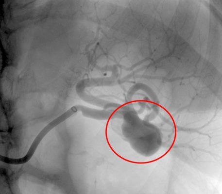Aneurisma Sacular Esplênico tratado com micromolas