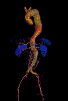 Aneurisma da aorta abdominal (AAA) justa renal com renais acessórias corrigido com endoprótese fenestrada via percutânea femoral