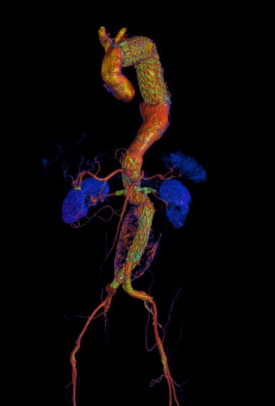 Aneurisma da aorta abdominal (AAA) justa renal com renais acessórias corrigido com endoprótese fenestrada via percutânea femoral