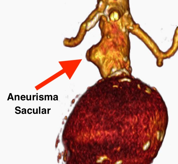 Aneurismas sacular