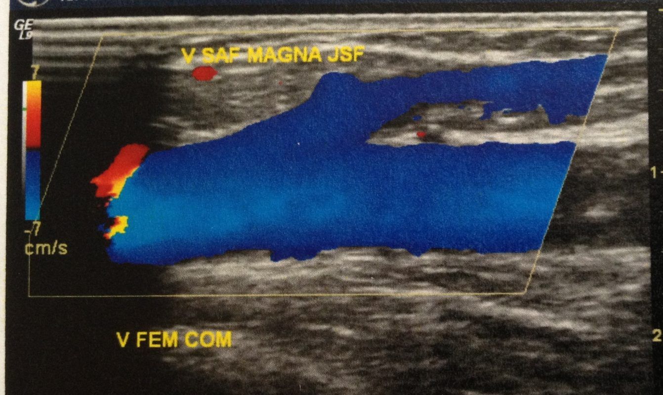 DIAGNÓSTICO-ECODOPPLER-VENOSO