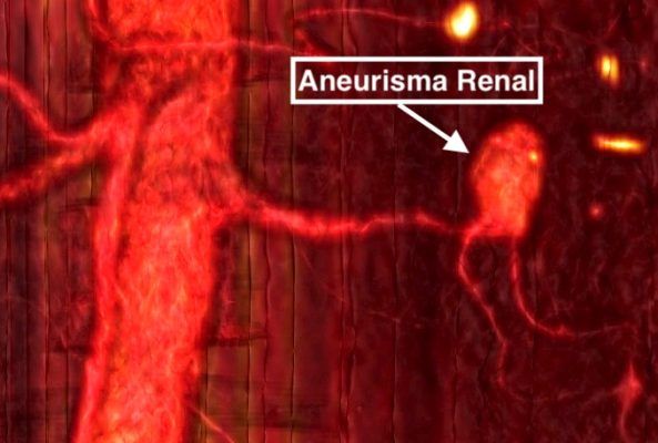 Aneurisma renal