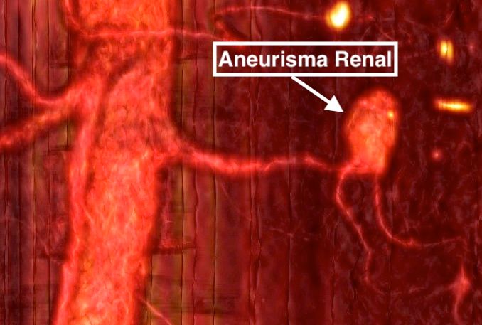 Aneurisma renal