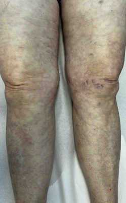 Livedo reticular
