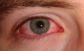 Red Eyes, Blurry Vision  and Floaters: Which Symptoms Need Urgent Attention?