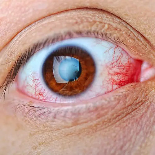 Understanding Glaucoma: The Silent Thief of Sight