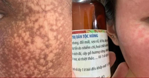 Mỹ Phẩm Trên Mạng: Cẩn Trọng Trước Nguy Cơ Biến Chứng