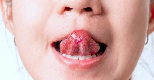 Bí mật sức khỏe từ lưỡi: Những điều bạn chưa biết