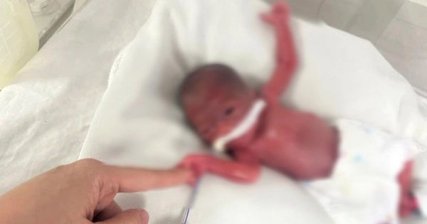 Hành Trình Kỳ Diệu: Bé Gái Sinh Cực Non 24 Tuần, 93 Ngày Hồi Sinh