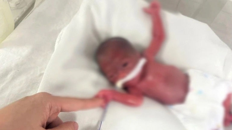 Hành Trình Kỳ Diệu: Bé Gái Sinh Cực Non 24 Tuần, 93 Ngày Hồi Sinh