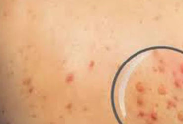 Bí ẩn bệnh đậu mùa khỉ tại Cà Mau: Sự lo lắng của cộng đồng