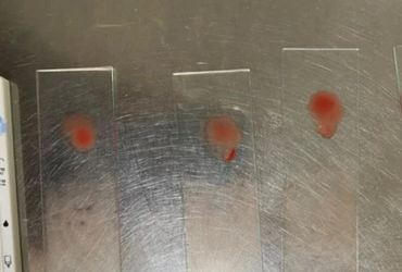 Hành Trình Chống Địch Sốt Rét: Bài Học từ Ca Bệnh Ngoại Lai ở Huế