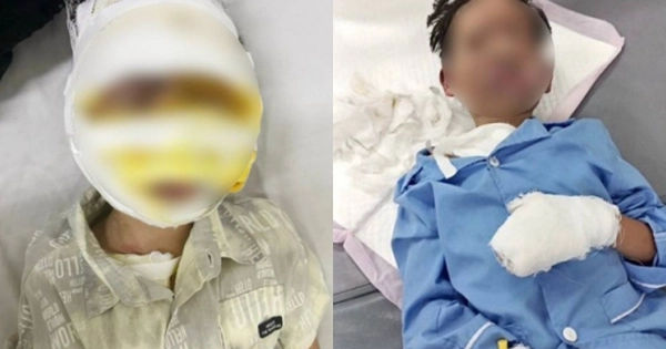 Nguy cơ bỏng cho trẻ em khi sử dụng laptop và điện thoại: Cẩn trọng từng bước