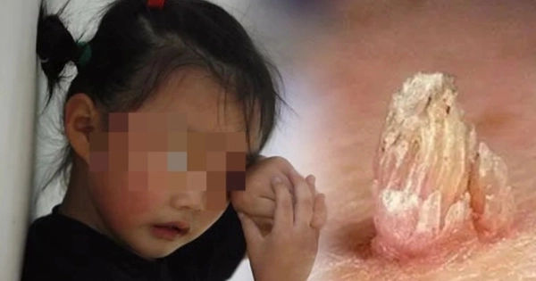 Bí mật ít ai biết về nguyên nhân gây bệnh sùi mào gà cho trẻ nhỏ