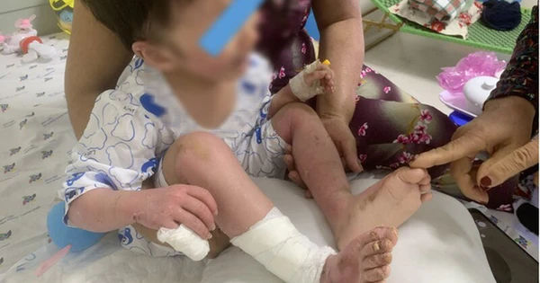 Hành trình chữa trị vết bỏng nặng của bé gái sau vụ phát nổ bếp gas