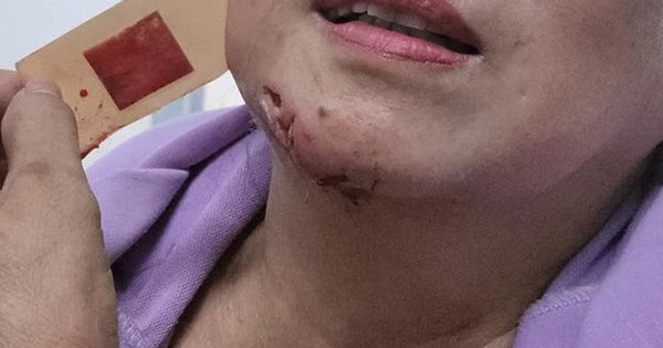 Cuộc chiến chống lại bệnh dại: Sức mạnh của vắc-xin và huyết thanh