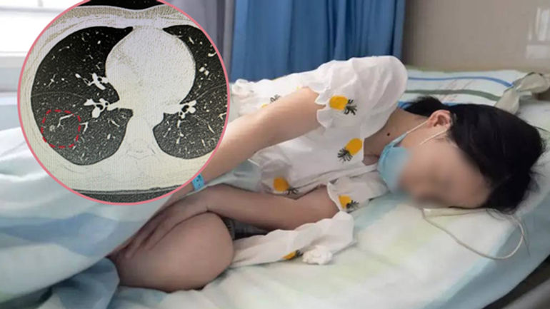 Ung Thư Phổi: Khám Phá và Phòng Ngừa