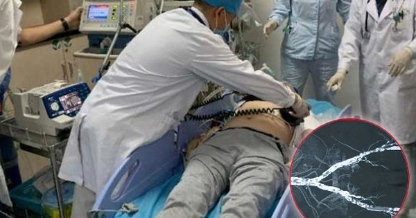 Bí mật đằng sau mạch máu vôi hóa như ruột bút chì: Câu chuyện đầy kinh ngạc