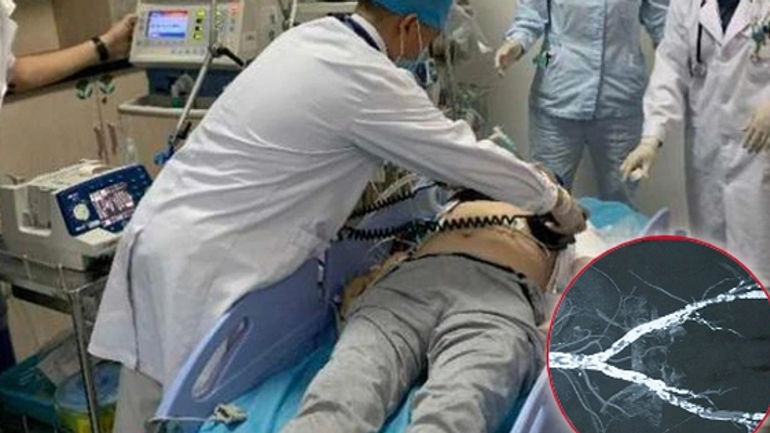 Bí mật đằng sau mạch máu vôi hóa như ruột bút chì: Câu chuyện đầy kinh ngạc