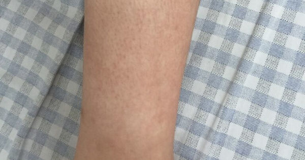 Sức Khỏe Của Bạn: Đừng Bỏ Lỡ Những Dấu Hiệu Của Sốt Xuất Huyết