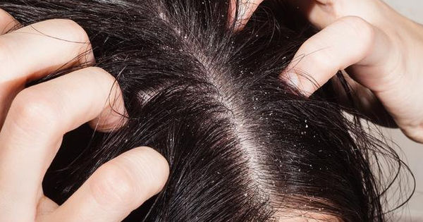 Ngứa da đầu: 4 cơn ngứa đáng lo ngại cần được chú ý