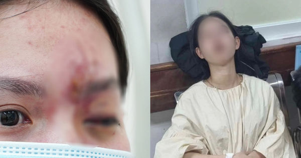 Biến chứng sau tiêm filler: Cảnh báo từ trường hợp N.H.T.