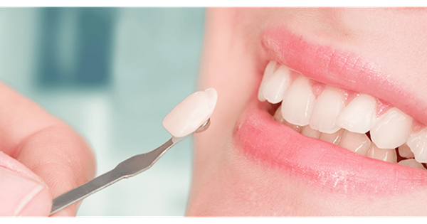 Những lợi ích đáng kinh ngạc từ dán sứ veneer