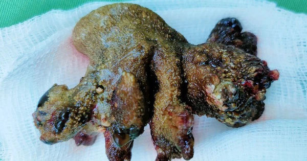 Lấy khối sỏi san hô lớn trong thận: Bí quyết hiệu quả cho người bệnh