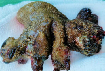 Lấy khối sỏi san hô lớn trong thận: Bí quyết hiệu quả cho người bệnh