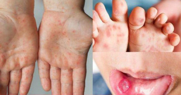 Đội ngũ 'siêu anh hùng': 21000 ống thuốc điều trị tay chân miệng dạng tiêm chốt đến Việt Nam