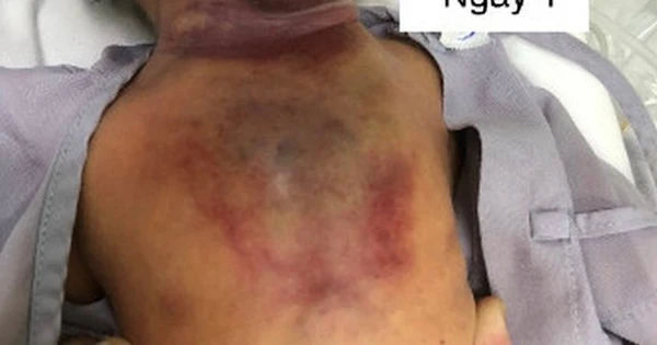 Bé gái 1 ngày tuổi mắc phải bệnh hiếm gây khó thở, sự chú ý về suy hô hấp tăng cao