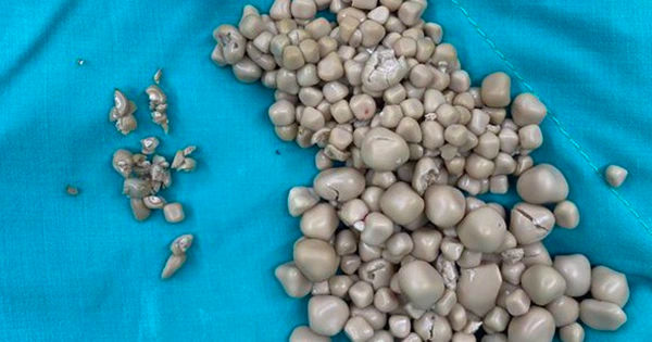 Cô gái trẻ 20 tuổi bị 300 viên sỏi thận vì 2 thói quen xấu