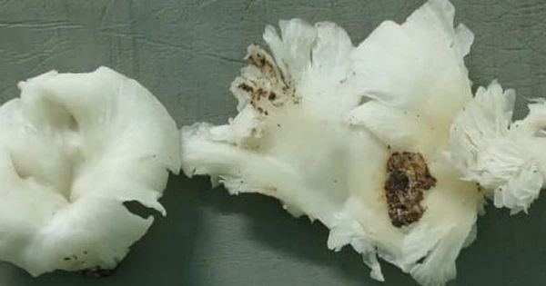 Những nguy hiểm khi ăn nấm lạ: 3 thành viên gia đình ở Quảng Nam gặp phải co giật và rối loạn tim mạch