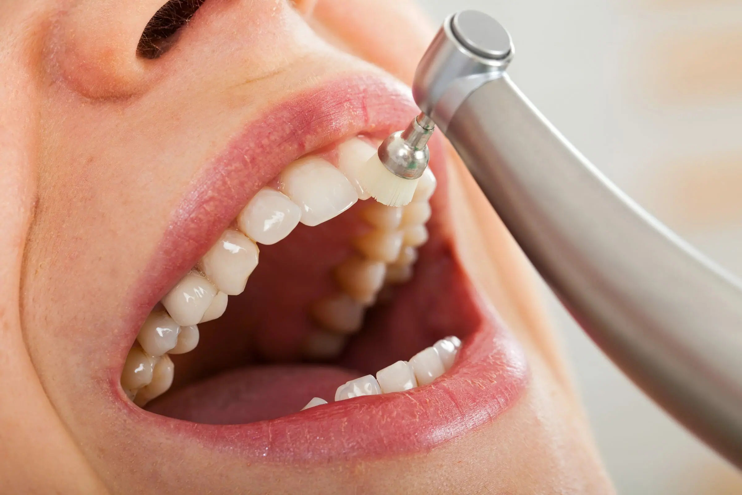 Professional Teeth Cleaning Rock Hill SC | Rock Hill Dentist Pros