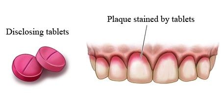 dental plaque disclosed