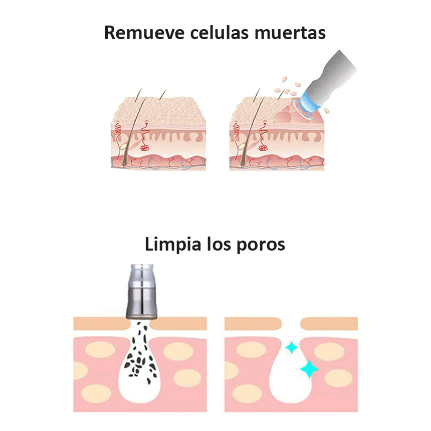 microdermoabrasión como funciona