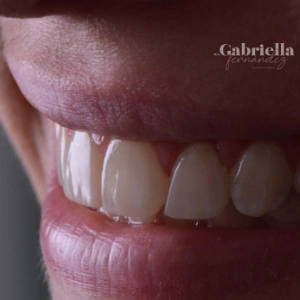 Cómo mejorar tu sonrisa con carillas dentales
