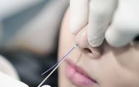 Threading Nose
