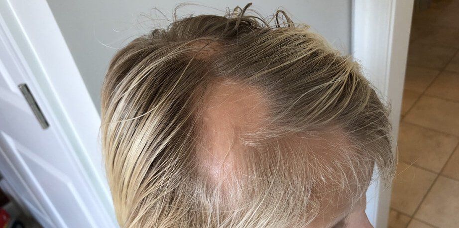 Alopecia Areata