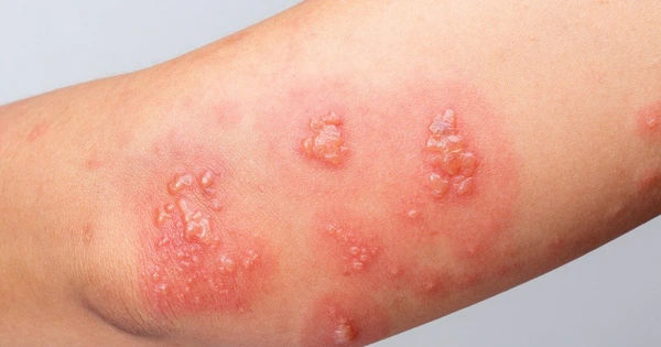 Hành trình vượt qua sốc phản vệ do dị ứng côn trùng