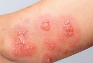 Hành trình vượt qua sốc phản vệ do dị ứng côn trùng