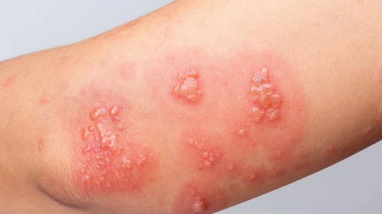 Hành trình vượt qua sốc phản vệ do dị ứng côn trùng