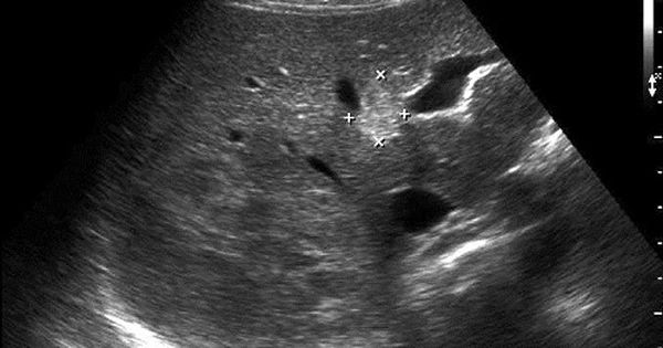 Những Bí Mật Ít Ai Biết Về Sán Lá Gan và Cách Phòng Tránh