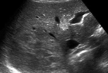 Những Bí Mật Ít Ai Biết Về Sán Lá Gan và Cách Phòng Tránh