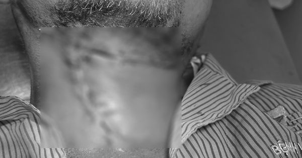 Khám phá về Viêm tấy sàn miệng lan tỏa Lugwigs angina