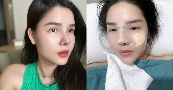 Chuyện "Mũi Đẹp" Của Kỳ Hân: Sự Thay Đổi Không Ngờ